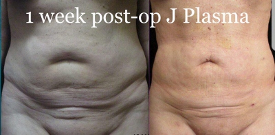 J-Plasma Skin Tightening